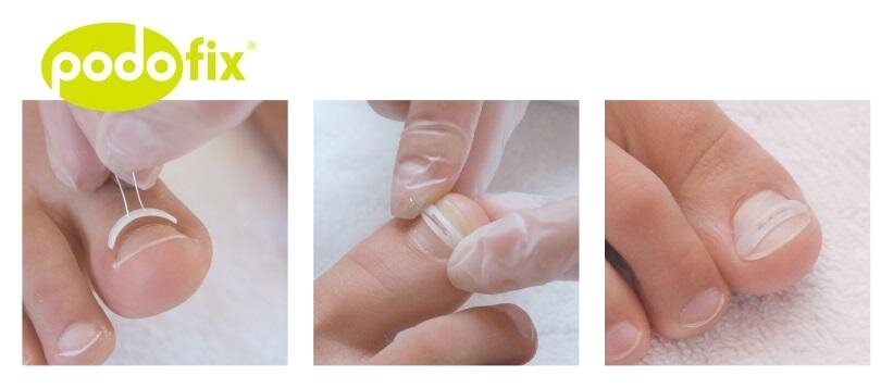 Anwendung Podofix